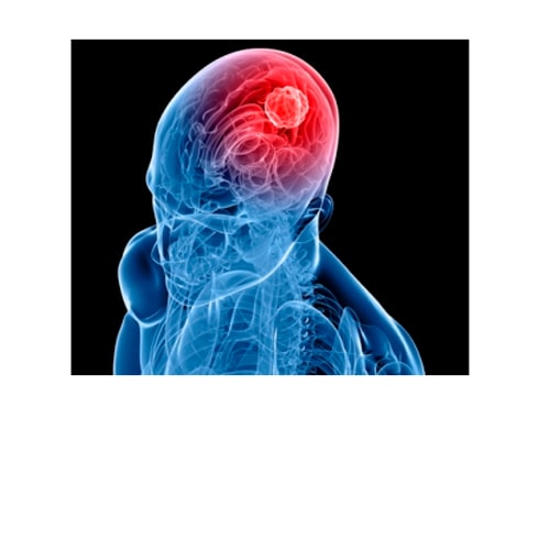Cranial Tumor