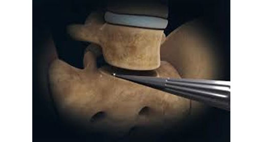 Lumbar Disc Replacement Surgery